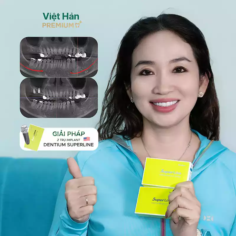 Hình ảnh chị khách cấy 2 trụ implant Superline tại Việt Hàn Premium