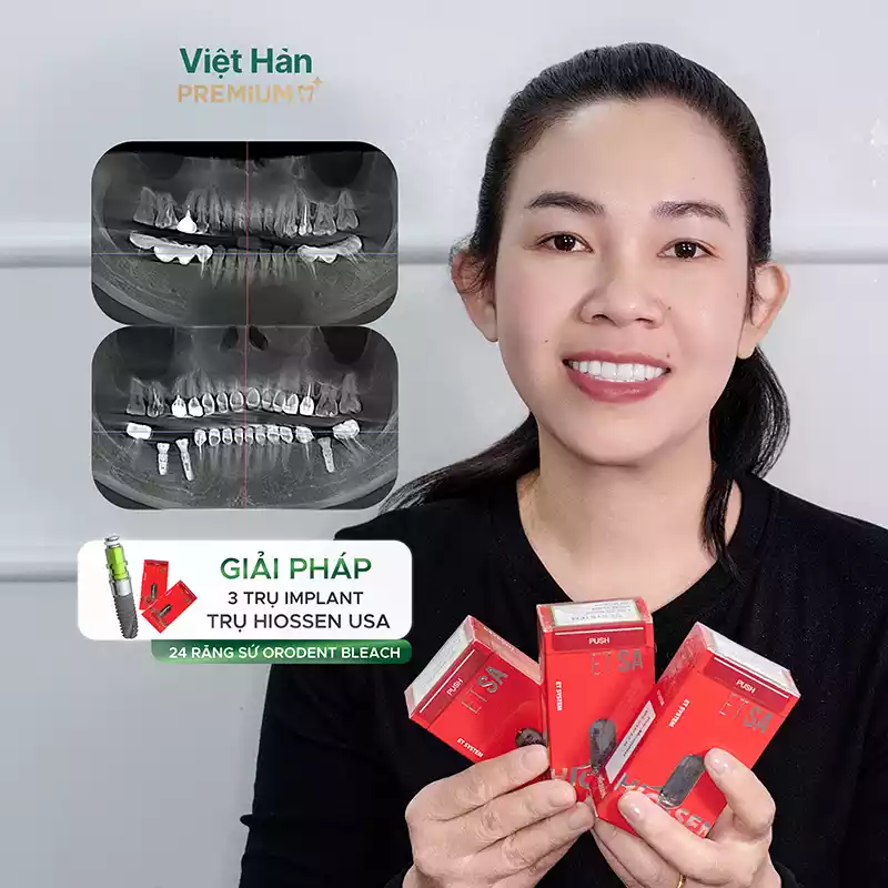 Hình ảnh khách cắm 3 trụ Implant Hiossen USA và thẩm mỹ 24 răng sứ Orodent Bleach