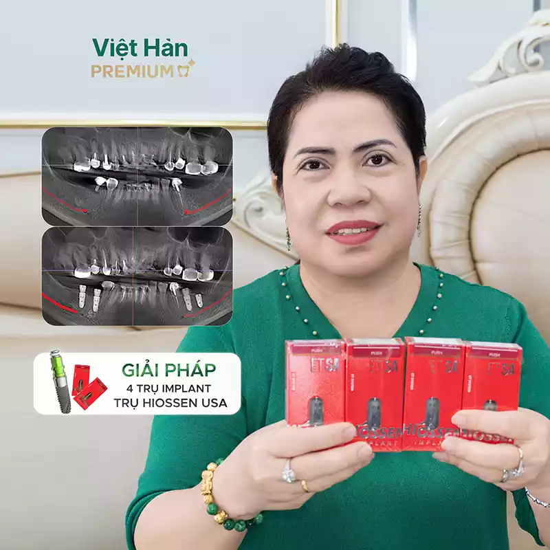 Hình ảnh giải pháp cắm 4 trụ Implant Hiossen Mỹ tại Nha khoa Việt Hàn Premium