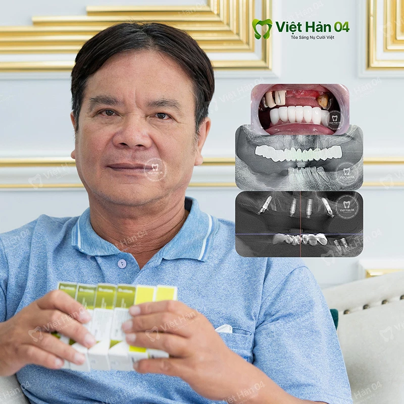 Giải pháp Implant toàn hàm All On 4 hàm trên