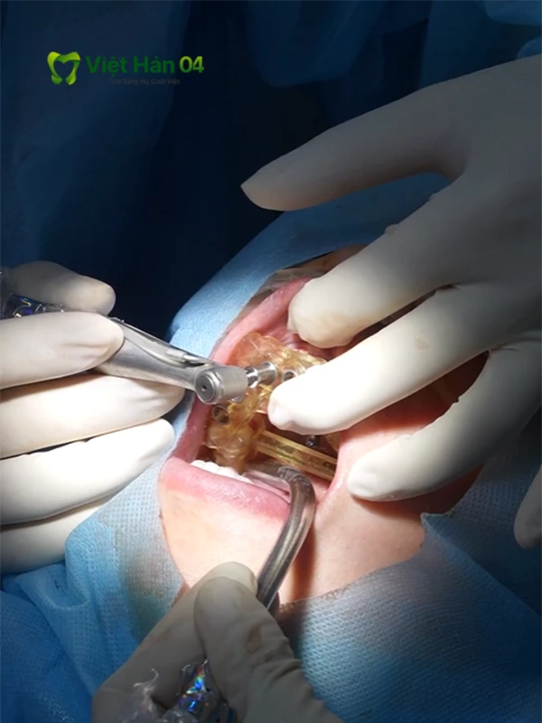 Công nghệ máng định vị cấy ghép Implant