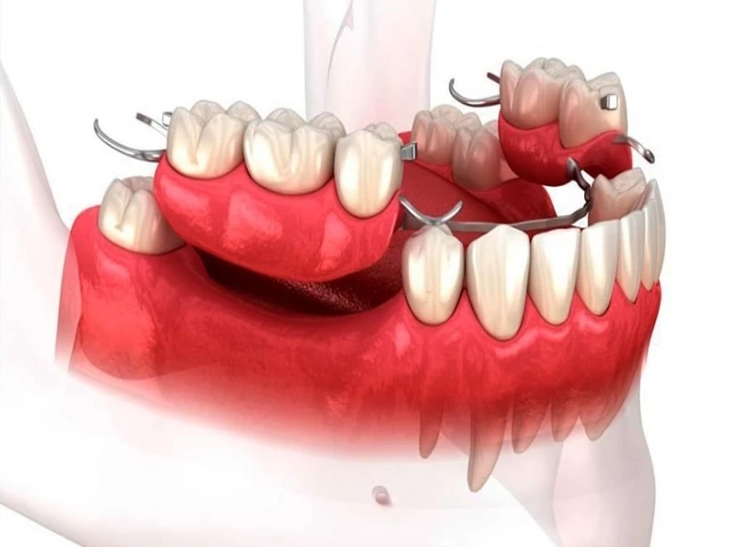 Hàm giả tháo lắp giúp tiết kiệm chi phí và dễ dàng tháo gỡ để vệ sinh