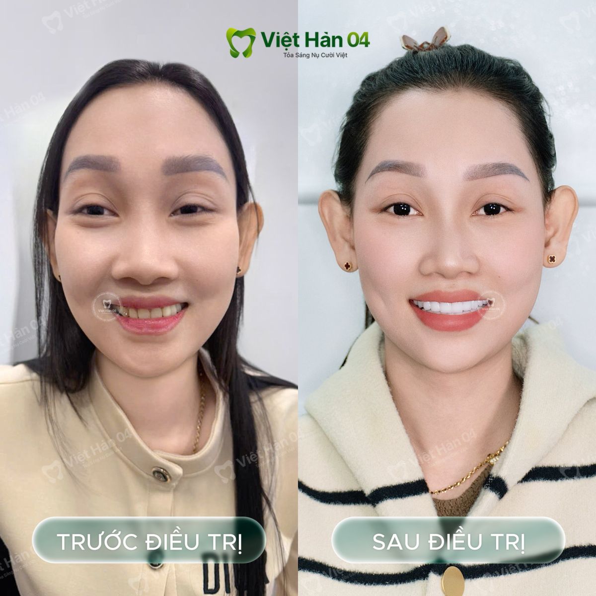Hình ảnh khách hàng Cẩm Tú - Giải pháp bọc 22 răng sứ Orodent White