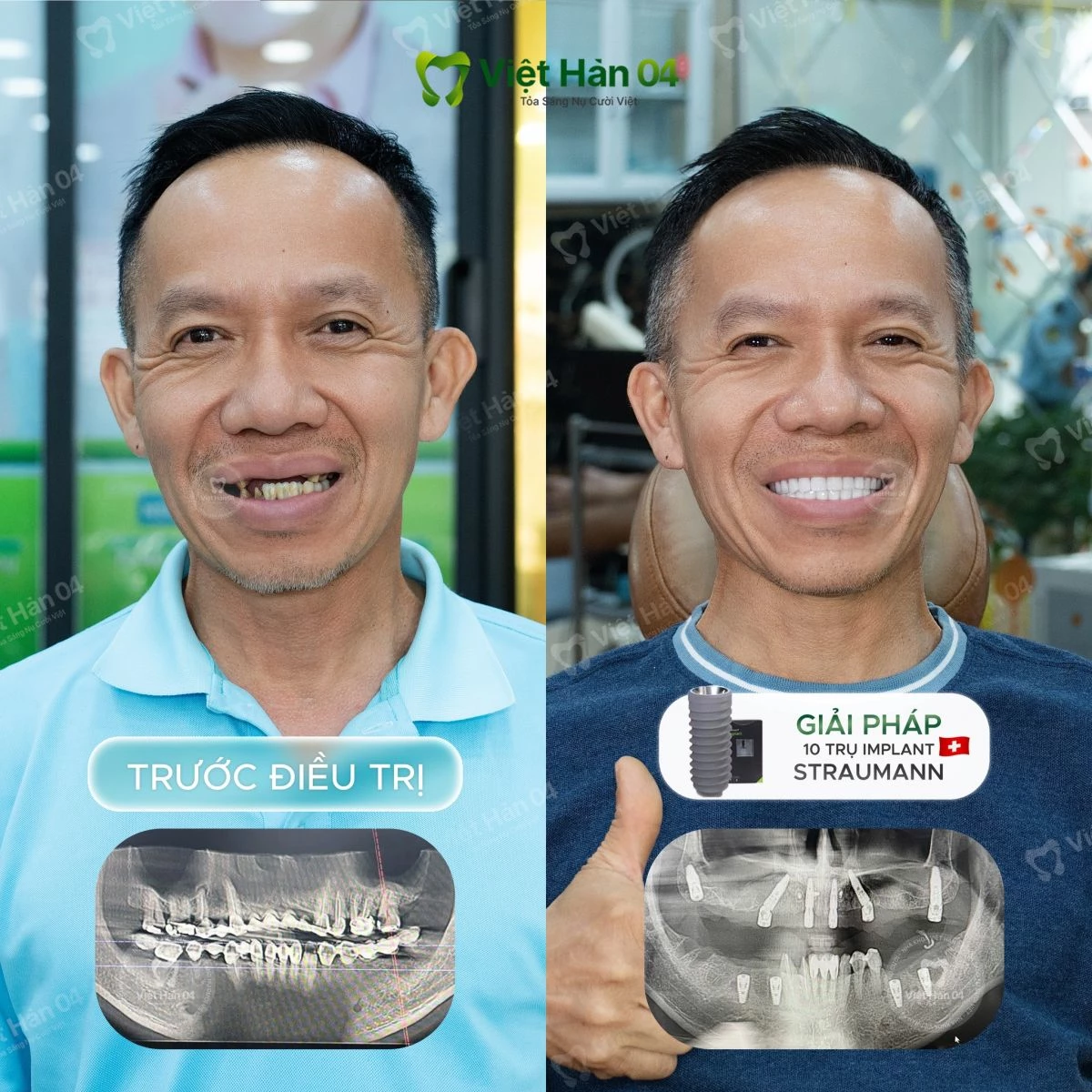 Giải pháp: Cấy ghép 10 trụ Implant Strauman