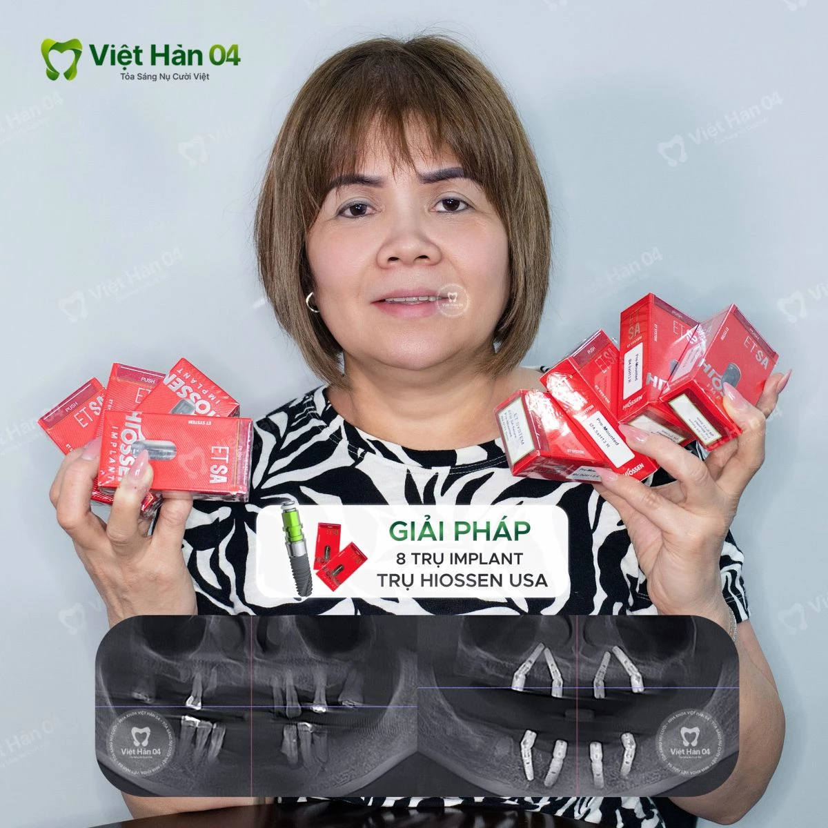 Giải pháp: Implant toàn hàm All On 4 với 8 trụ Hiossen, áp dụng công nghệ máng định vị.