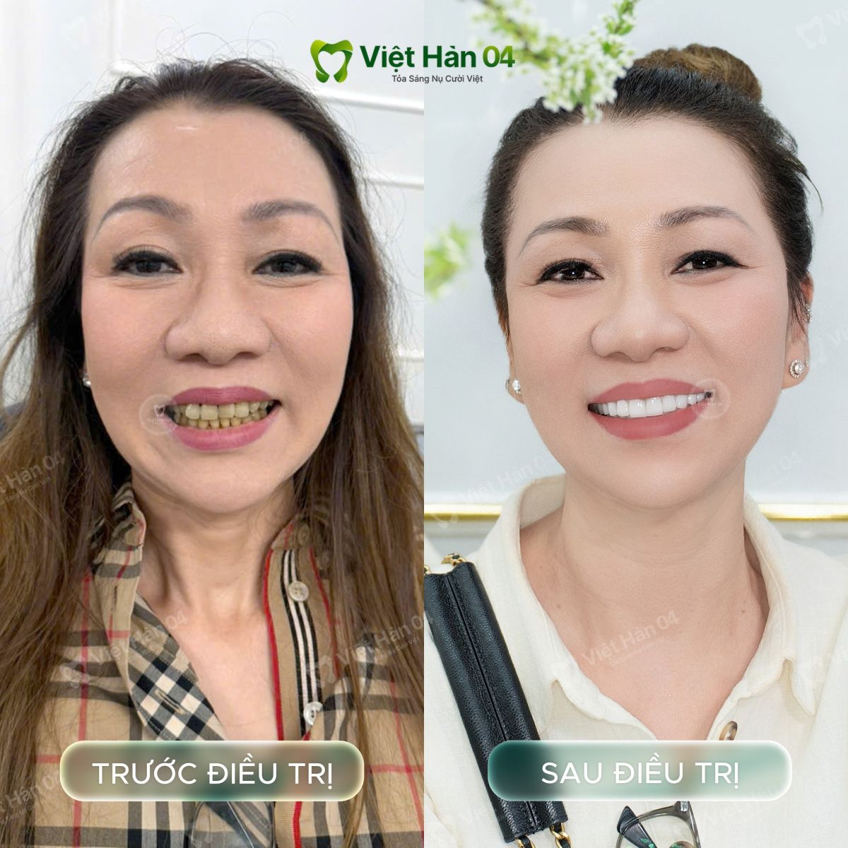 Hình ảnh khách hàng Hương Nguyễn - Giải pháp bọc 20 răng sứ Lava Plus