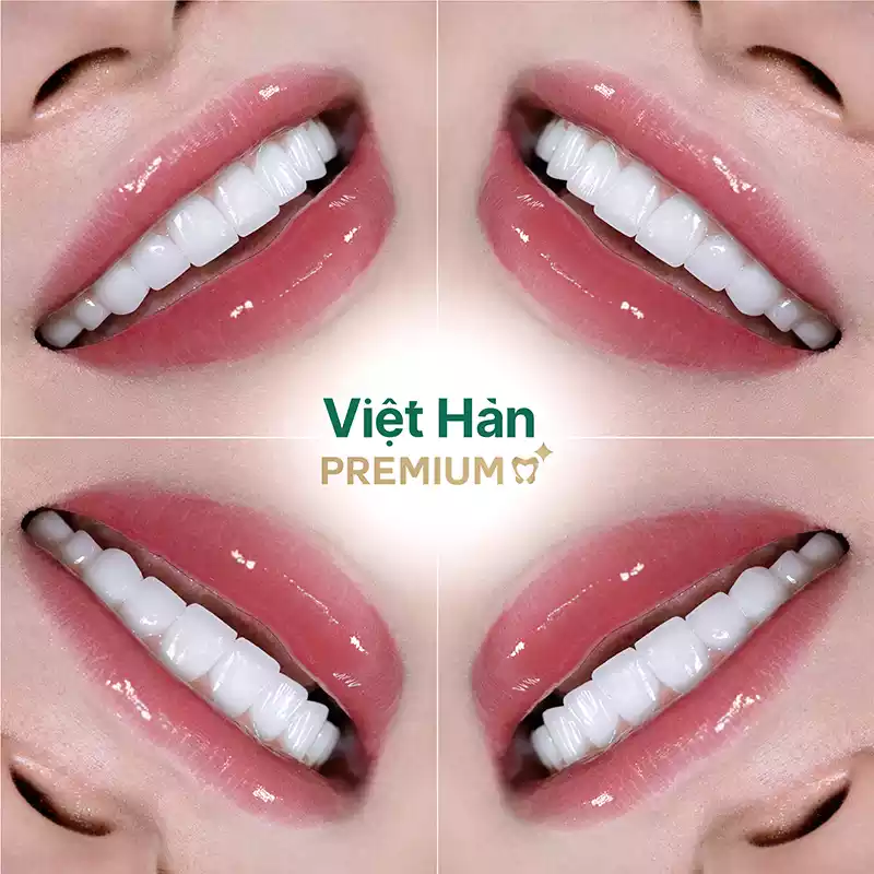 Hình ảnh làm răng sứ trong suốt đẹp lấp lánh
