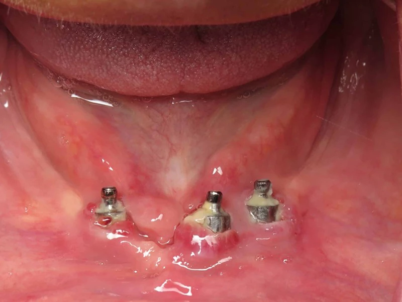 Sưng tấy, chảy mủ: Vùng nướu quanh trụ Implant bị viêm nhiễm, sưng đỏ hoặc có mủ hôi.