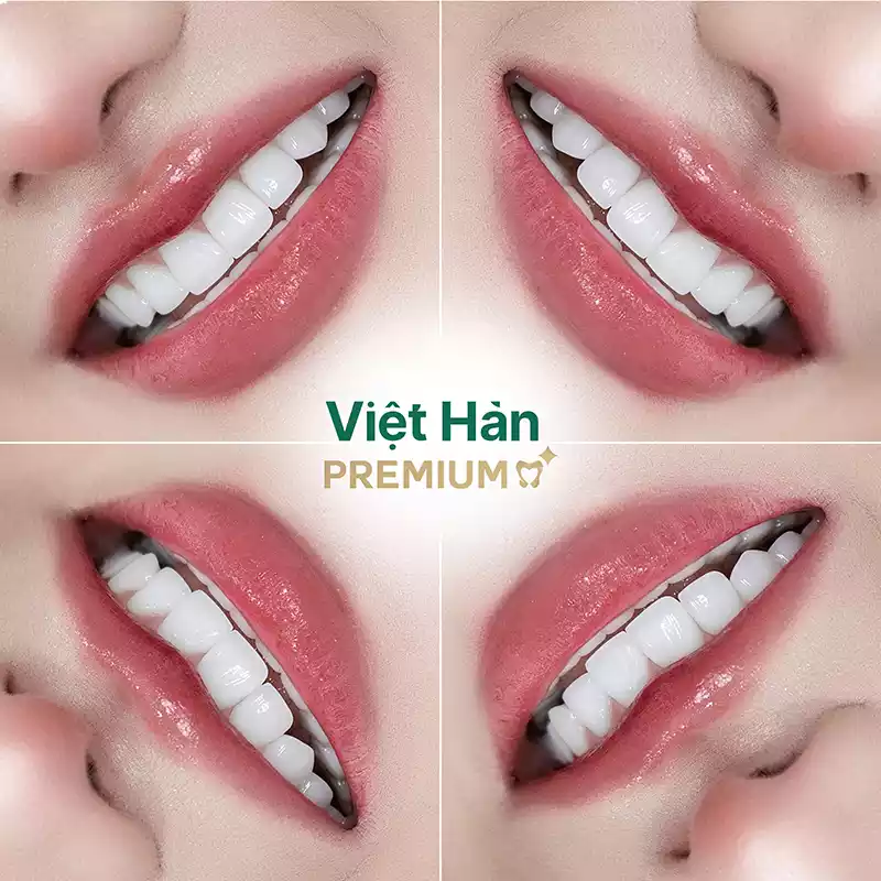 Hình ảnh răng sứ trong suốt