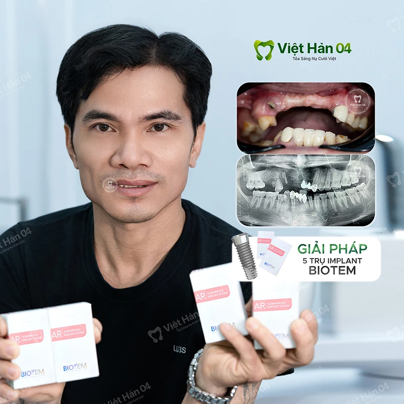 Implant 5 trụ Biotem Hàn Quốc