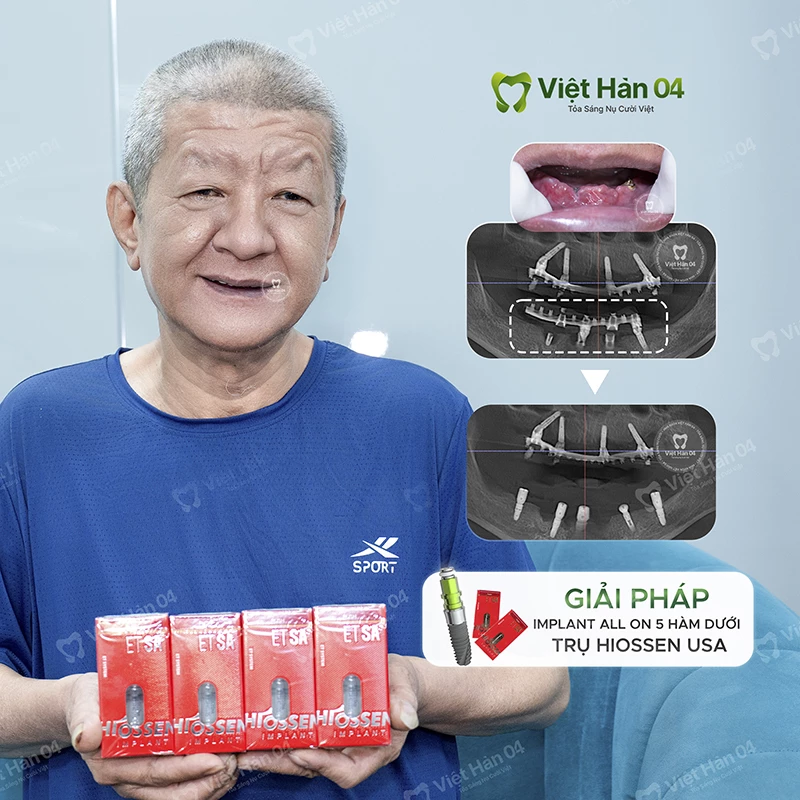 Implant All On 5 hàm dưới trụ Hiossen USA