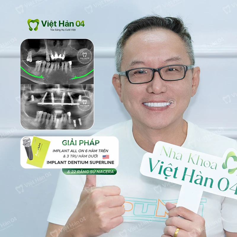 Implant All On 6 hàm trên & 3 trụ hàm dưới USA - Implant Dentium SuperLine