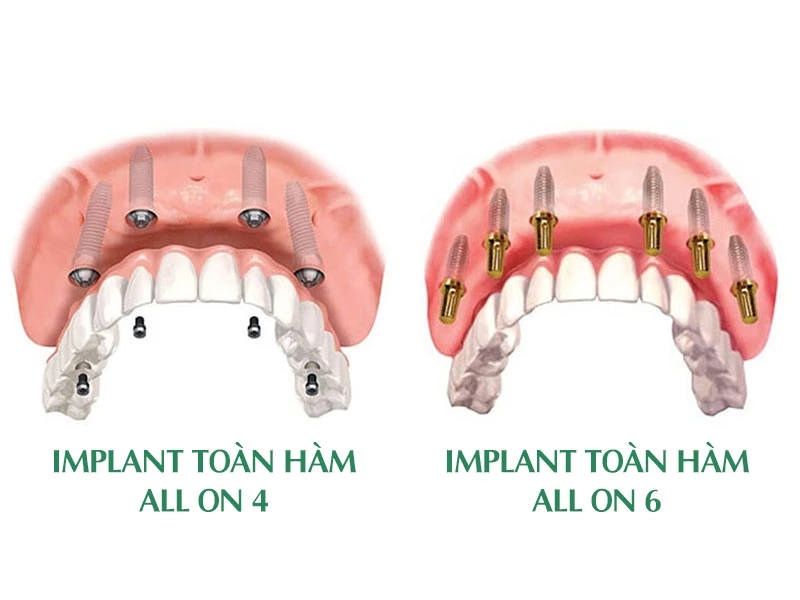 Implant toàn hàm All On 4 - 6