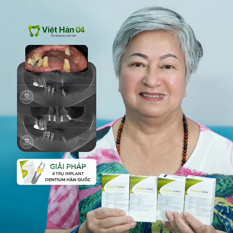 Kết quả trồng răng implant all on 4 - Implant Dentium Hàn Quốc