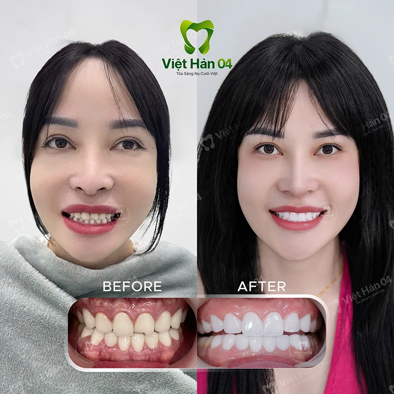 Khách hàng chị Thủy làm sứ 2 hàm - Nha Khoa Việt Hàn 04