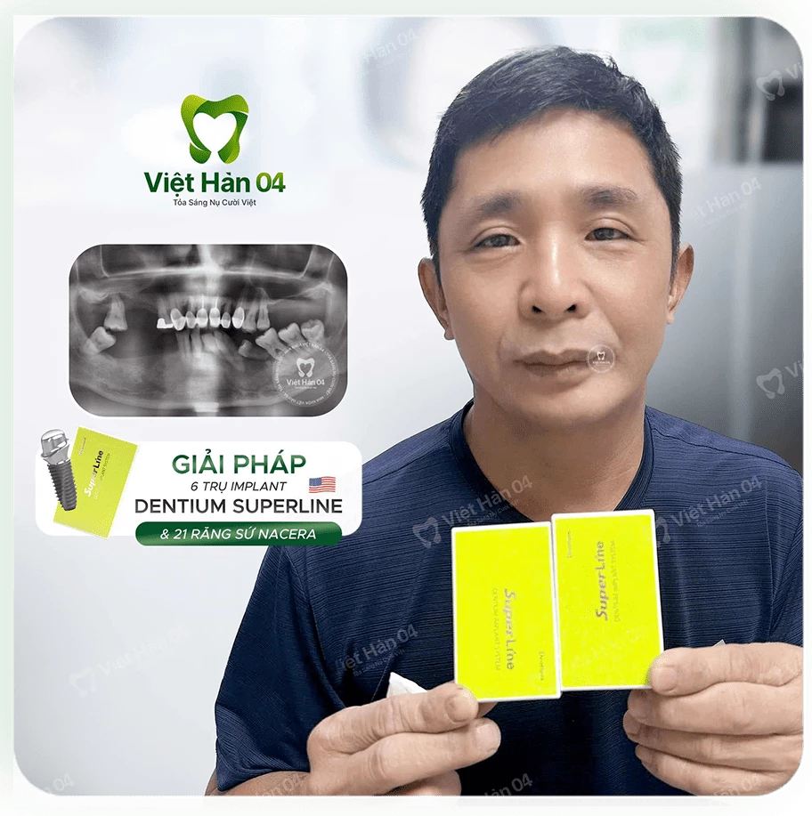 Hình ảnh khách Đài Loan qua Việt Nam để cấy 6 trụ Implant Dentium SuperLine và bọc 21 răng sứ Nacera