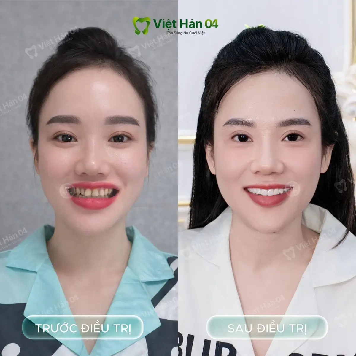 Khách hàng Hoàng Nhi - Bọc 22 răng sứ Lava 3M tại Nha khoa Việt Hàn 04