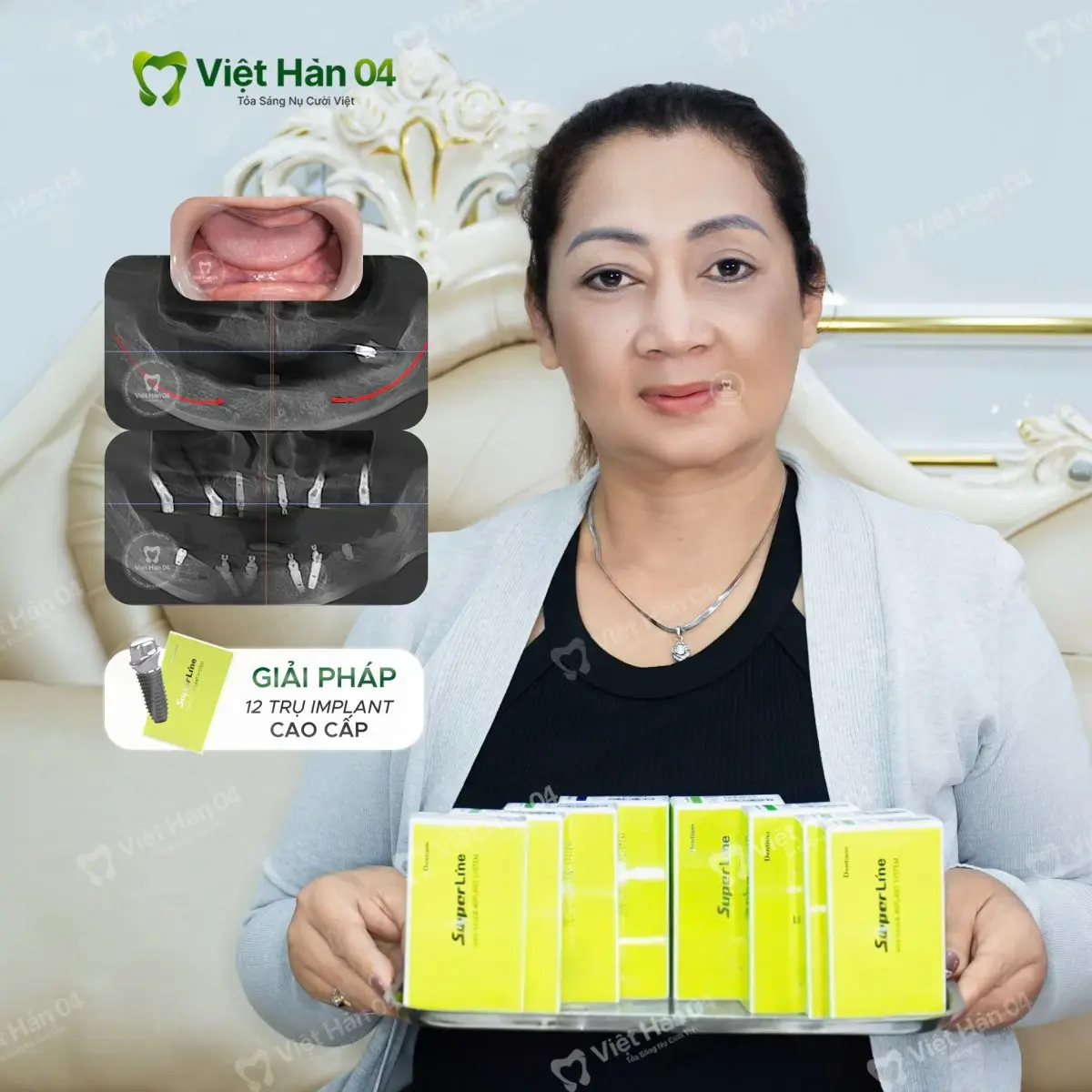 Khách hàng Joanna Khuu (Việt Kiều Úc) - Cấy ghép 12 trụ Implant Dentium Superline