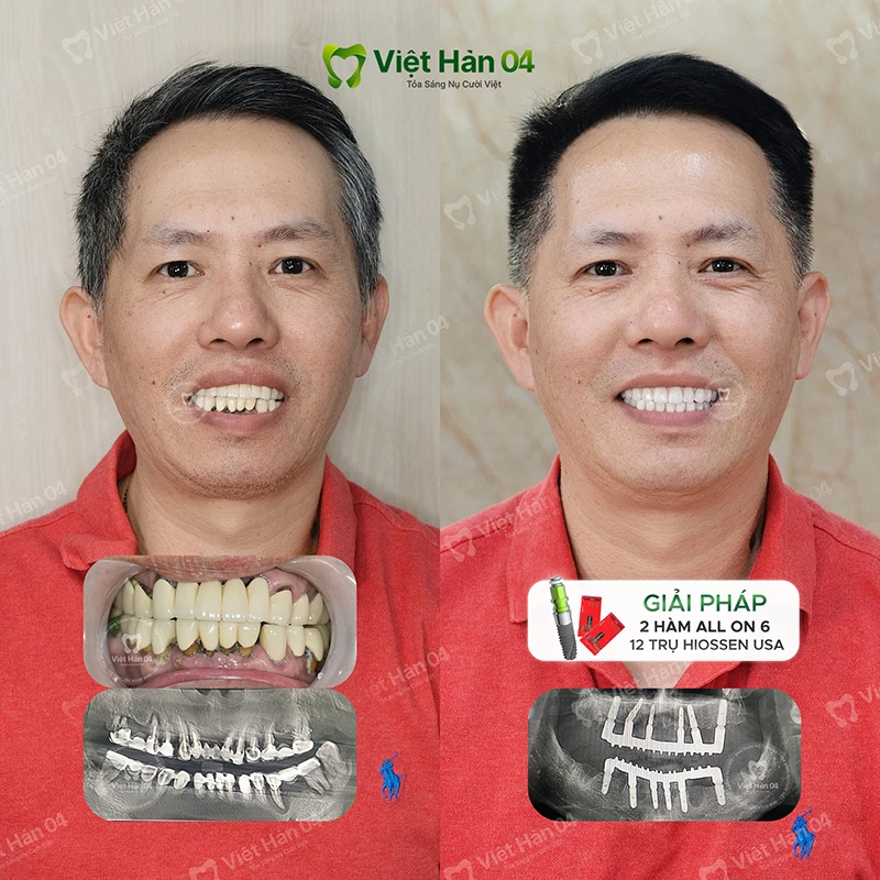 Khách hàng Kiến Toàn - Việt Kiều Úc - Cấy ghép Implant toàn hàm tại Nha khoa Việt Hàn 04