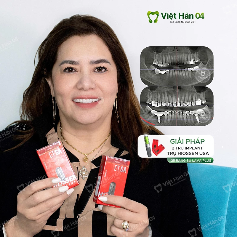 Khách hàng Kim Hoa - Việt Kiều Mỹ - Cấy ghép Implant đơn lẻ tại Nha khoa Việt Hàn 04