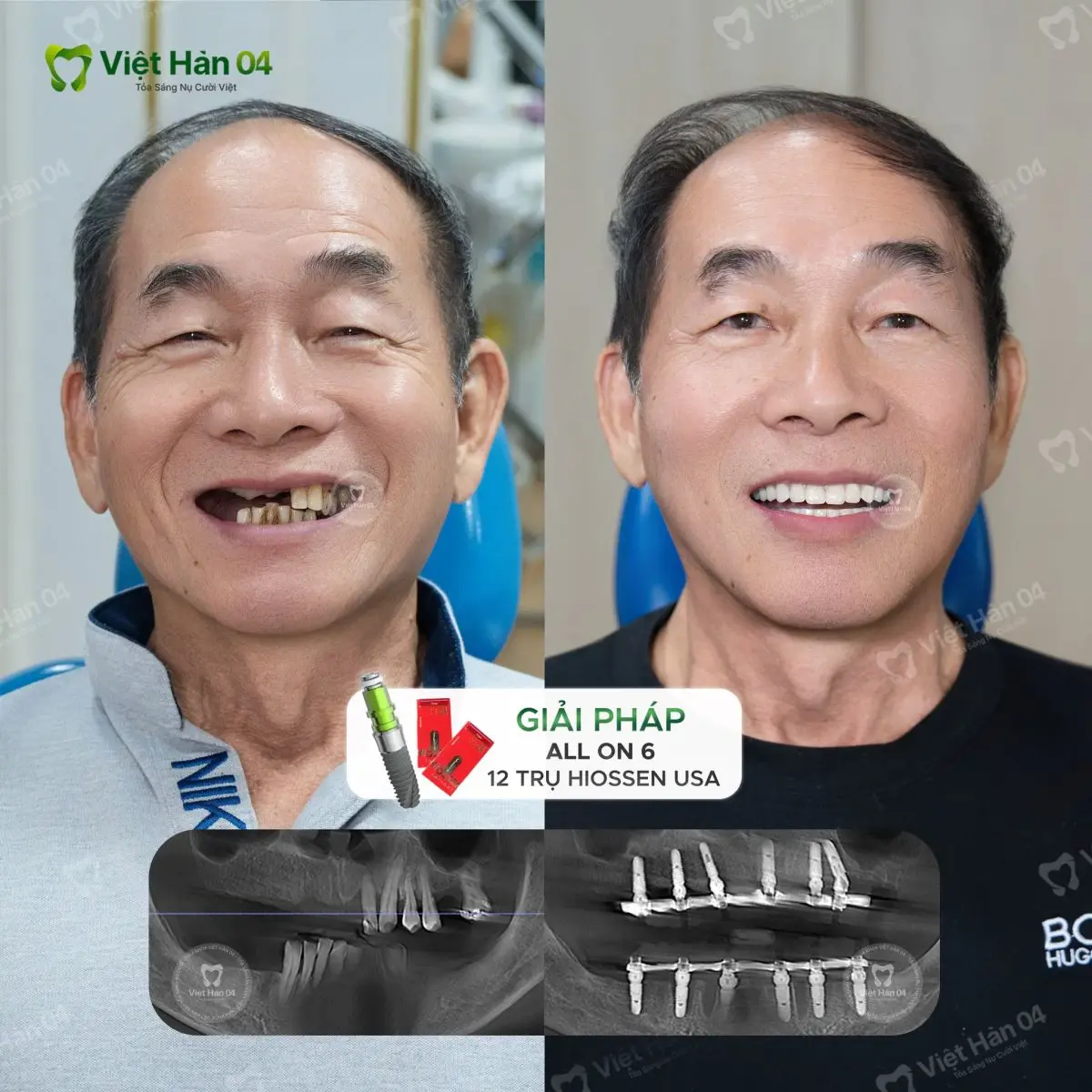 Khách hàng Lim Eng Sen (Malaysia) - Trồng răng Implant nguyên hàm All On 6 với 12 trụ Implant Hiossen