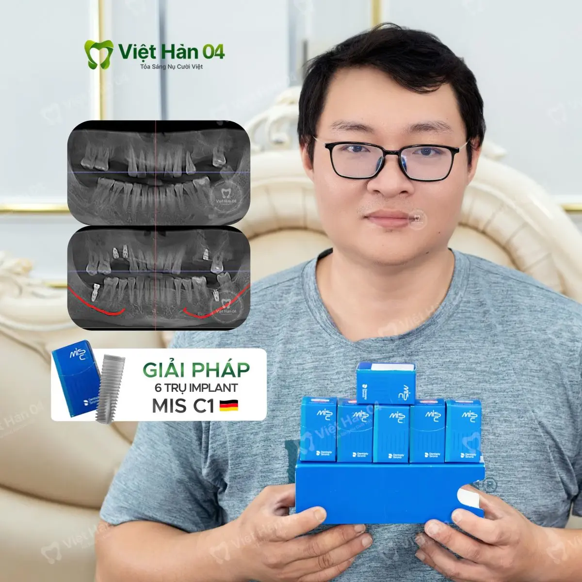 Khách hàng Lin Wei Ting (Đài Loan) - Cấy ghép 6 trụ Implant Mis C1 (Đức)