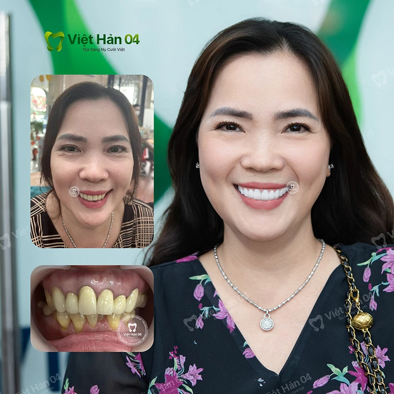 Khách hàng Ngọc Giàu làm 2 hàm sứ - Nha Khoa Việt Hàn 04
