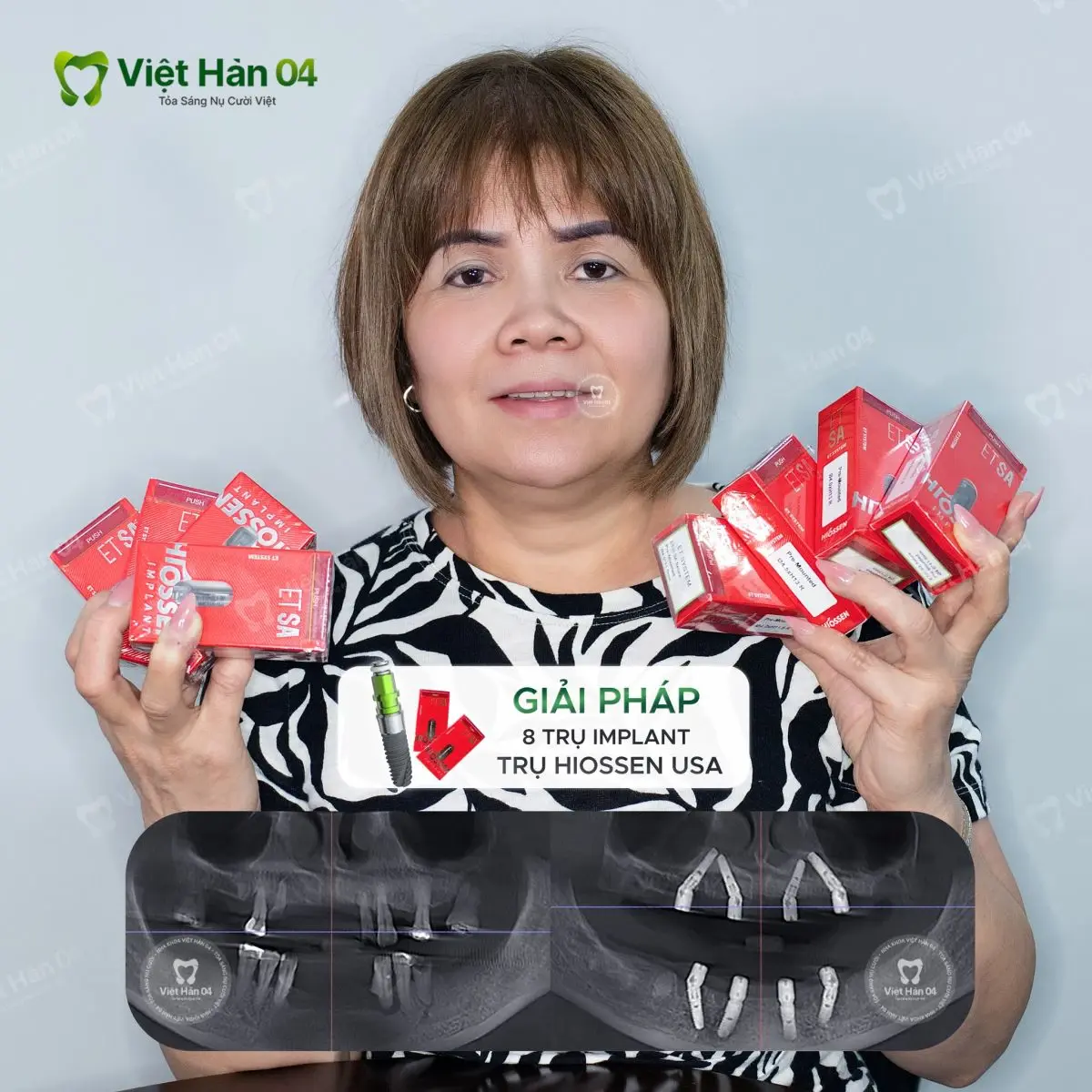 Khách hàng Phi Thủy - Trồng răng Implant toàn hàm All On 4 với 8 trụ Implant Hiossen USA