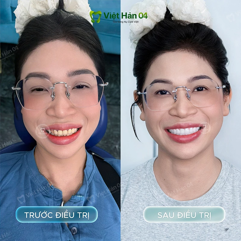 Khách Hàng Thảo Vi bọc sứ 2 hàm - Nha Khoa Việt Hàn 04