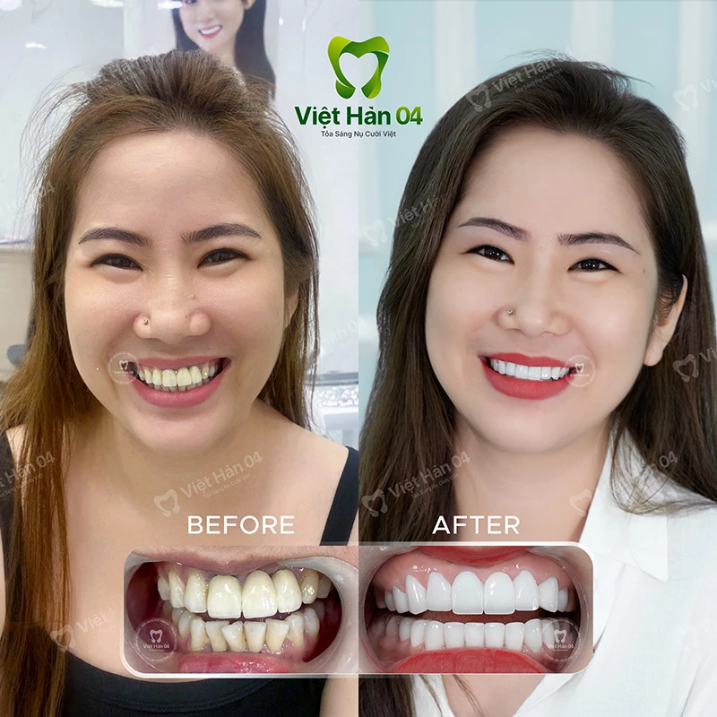 Khách hàng Thu Hương bọc răng sứ - Nha Khoa Việt Hàn 04