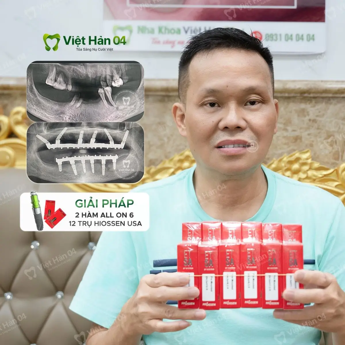 Khách hàng Vinh Tường - Cấy Implant nguyên hàm All-On-6 với 12 trụ Implant Hiossen