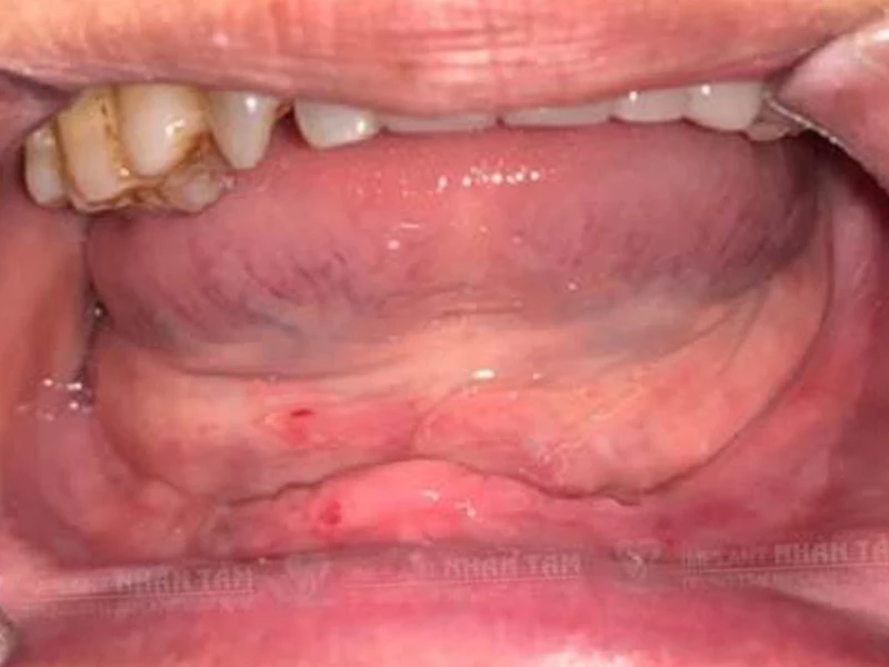 Mất răng toàn hàm dưới trước khi cắm implant