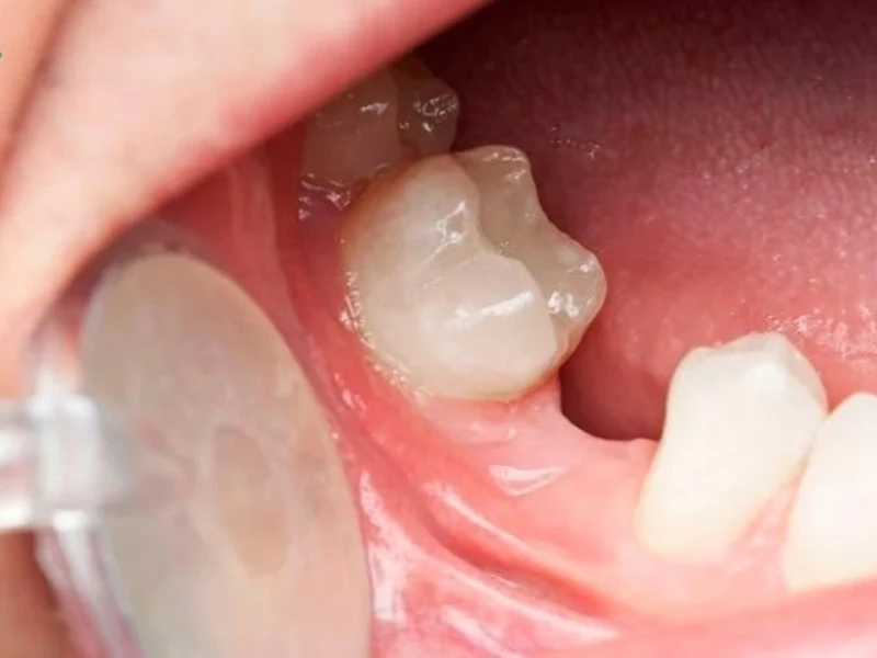 Tiêu xương hàm sau mất răng, khiến răng bên cạnh bị đổ nghiêng