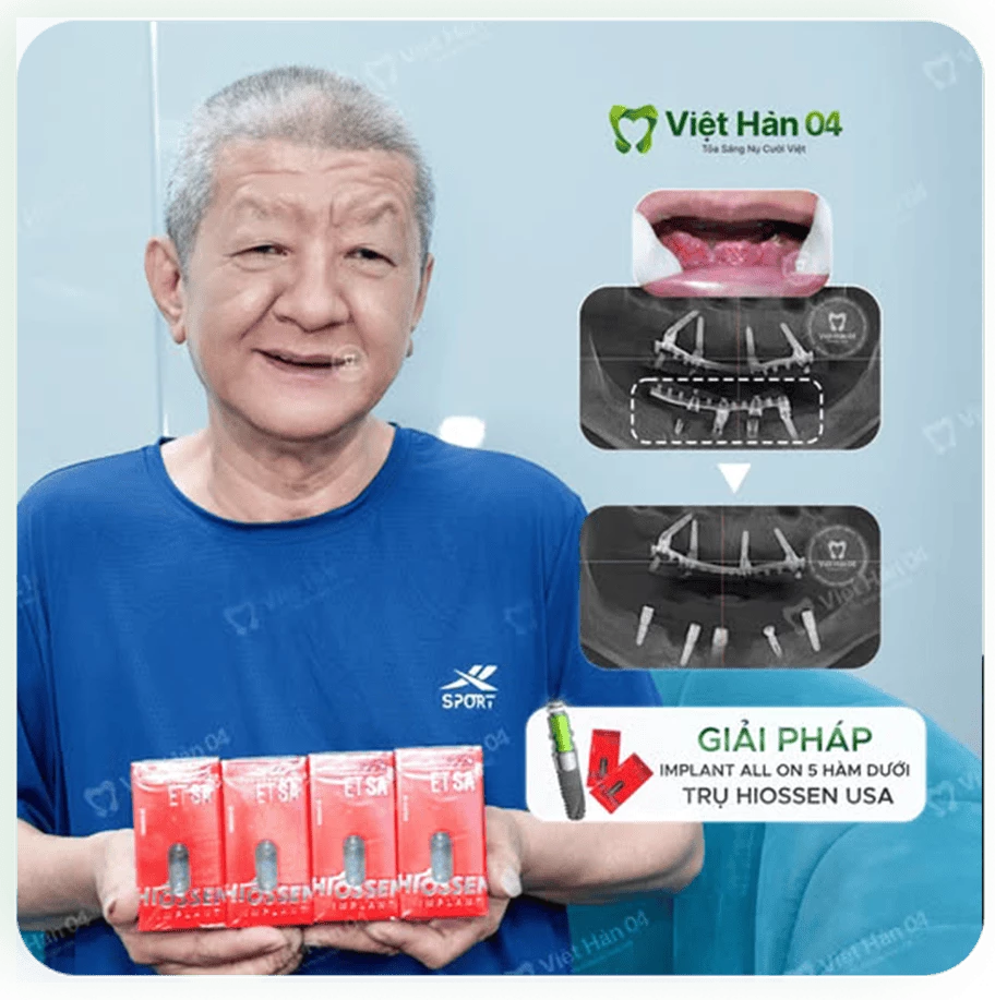 Giải pháp implant all on 5 hàm dưới trụ hisossen usa