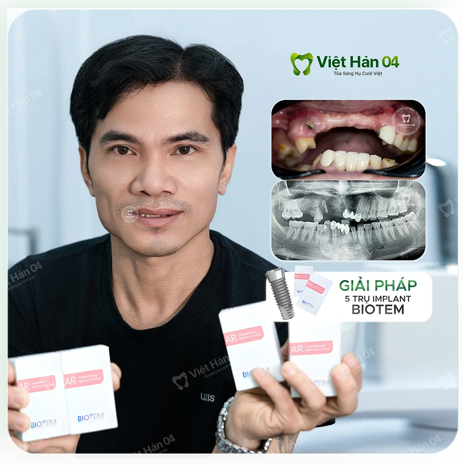 Giải pháp: Trồng 5 trụ Implant Biotem