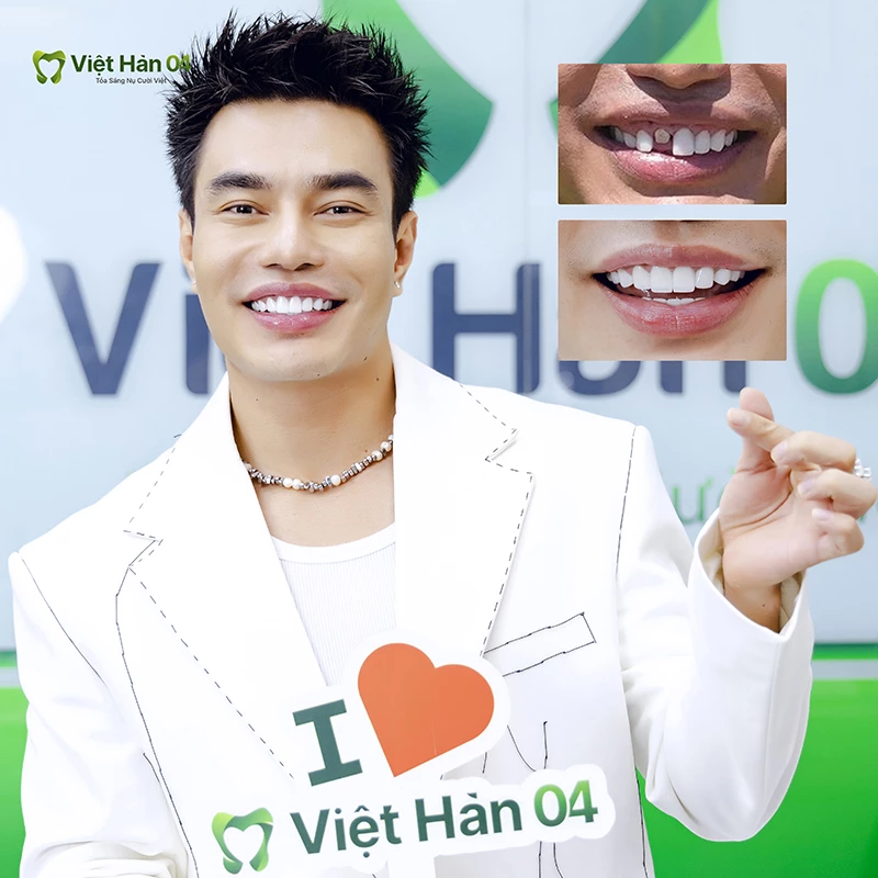 Lê Dương Bảo Lâm làm răng sứ tại Nha khoa Việt Hàn 04