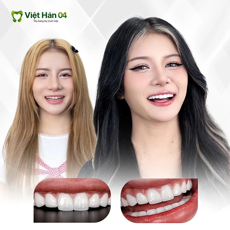 Tiktoker Xuân Ca làm răng sứ tại nha khoa Việt Hàn 04