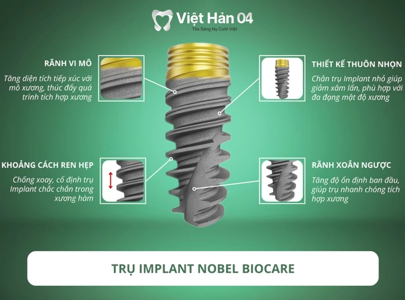 Nha khoa Việt Hàn 04 sử dụng trụ Implant Nobel của Mỹ chất lượng cao 