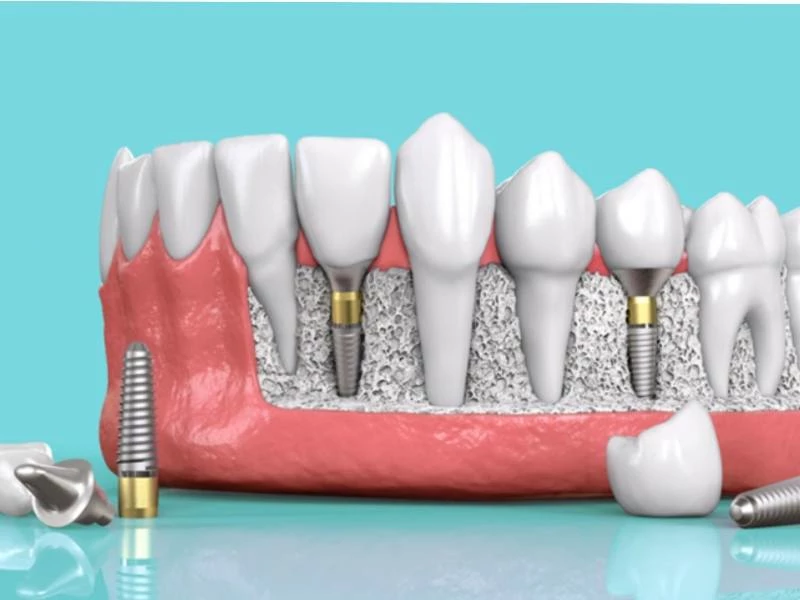 Những trường hợp nào nên trồng răng vĩnh viễn?