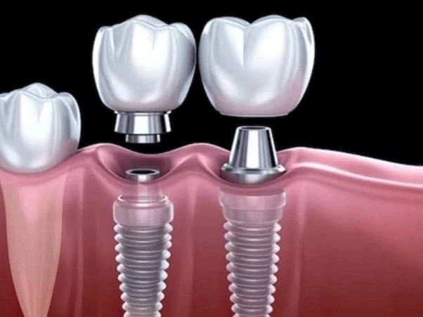 Implant đòi hỏi sức khỏe xương hàm đạt tiêu chuẩn 