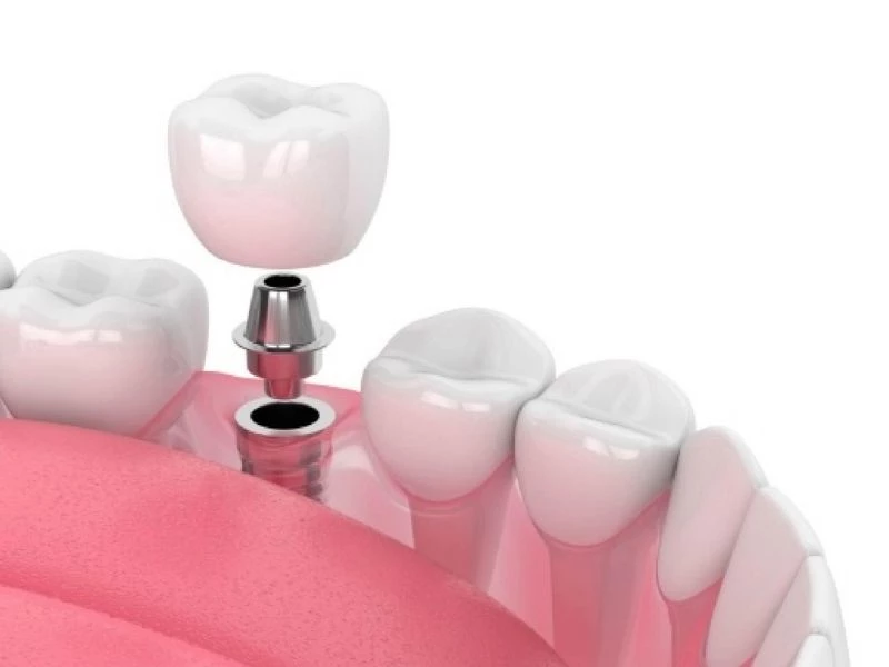 Thời gian hoàn thiện implant thường kéo dài nhiều tháng 
