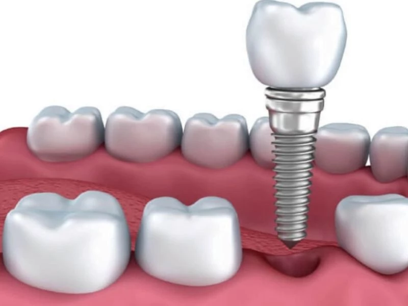 Cần tuân thủ hướng dẫn bác sĩ sau khi cấy ghép 