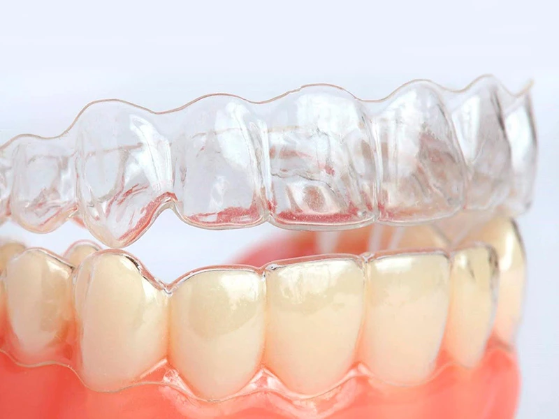 Hình ảnh khay niềng răng trong suốt invisalign