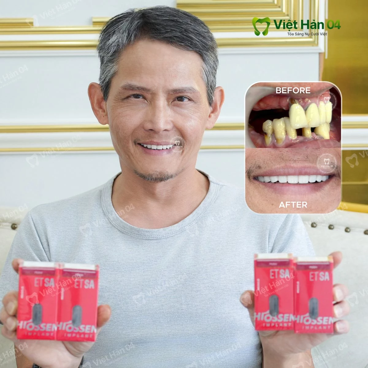 Đối tượng thích hợp trồng răng toàn hàm all on 4 - all on 6