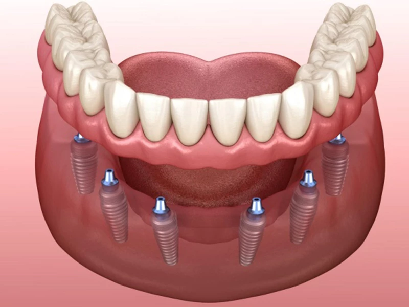 Phương pháp trồng răng Implant toàn hàm All On 6