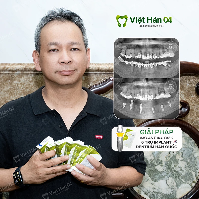 Phương pháp Implant All On 6 - Implant Dentium Hàn Quốc
