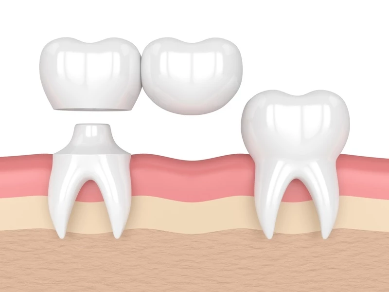 Phương pháp làm cầu răng sứ phục hình vị trí răng số 7 