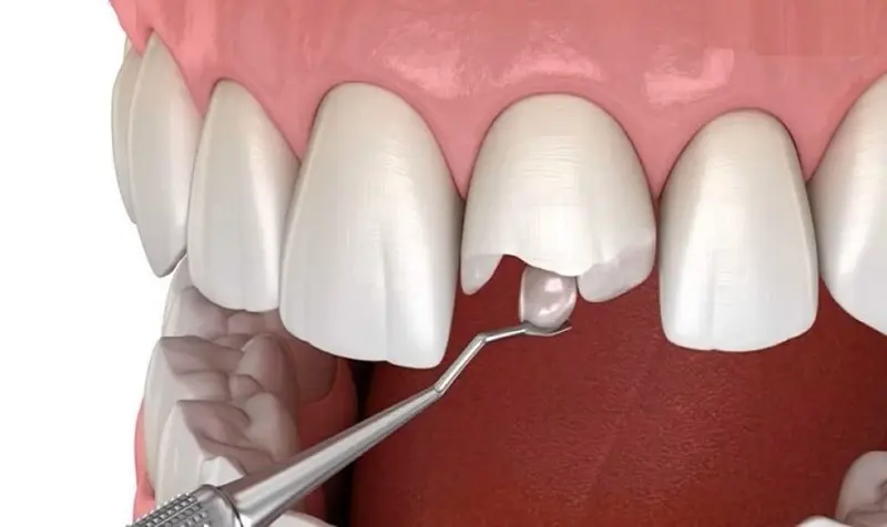Phương pháp trám răng composite phục hình chiếc răng cửa bị gãy mẻ nhẹ nhanh chóng