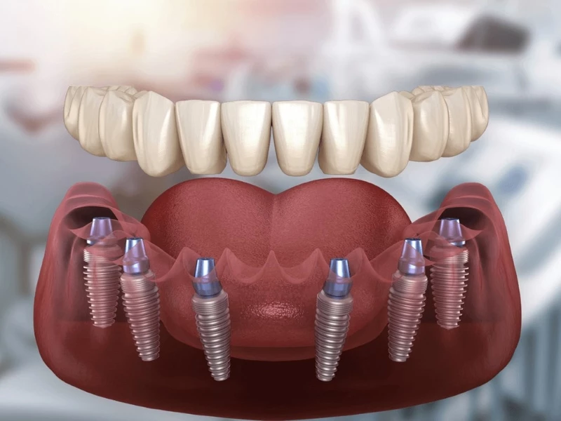 Phương pháp trồng răng implant nguyên hàm - All on 6