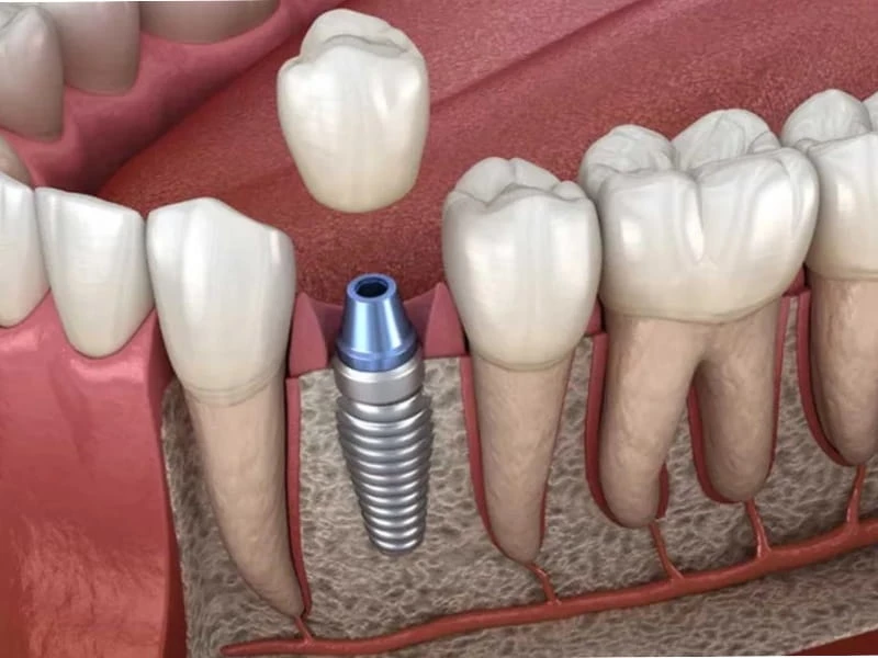 Quá trình trồng răng tương đối nhẹ nhàng